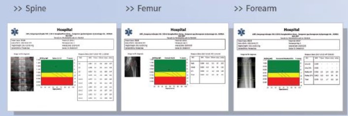 OSTEOPro MAX Fan 결과지 — Spine · Femur · Forearm